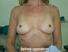 plastic-surgery-breast-augmentation