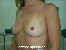 plastic-surgery-breast-augmentation