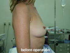 plastic-surgery-breast-augmentation
