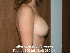plastic-surgery-breast-augmentation