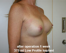 plastic-surgery-breast-augmentation