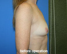 plastic-surgery-breast-augmentation