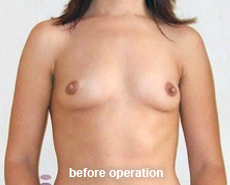 plastic-surgery-breast-augmentation