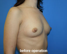 plastic-surgery-breast-augmentation