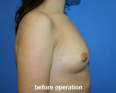 plastic-surgery-breast-augmentation