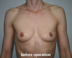 plastic-surgery-breast-augmentation