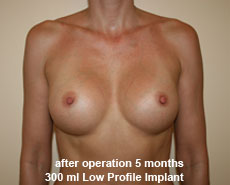 plastic-surgery-breast-augmentation