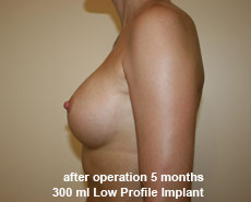 plastic-surgery-breast-augmentation