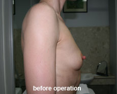 plastic-surgery-breast-augmentation