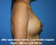 plastic-surgery-breast-augmentation