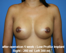 plastic-surgery-breast-augmentation