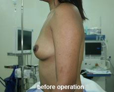plastic-surgery-breast-augmentation