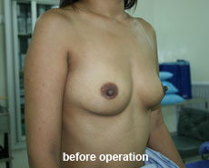 plastic-surgery-breast-augmentation