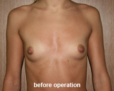 plastic-surgery-breast-augmentation