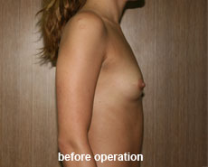 plastic-surgery-breast-augmentation