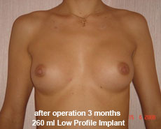 plastic-surgery-breast-augmentation