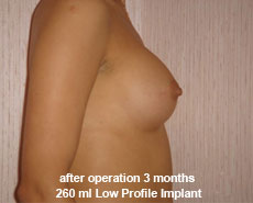 plastic-surgery-breast-augmentation