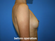 plastic-surgery-breast-augmentation