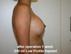 plastic-surgery-breast-augmentation