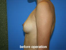 plastic-surgery-breast-augmentation