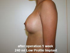 plastic-surgery-breast-augmentation