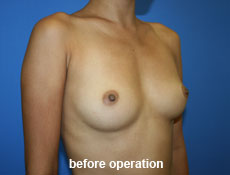 plastic-surgery-breast-augmentation