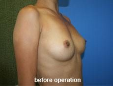 plastic-surgery-breast-augmentation