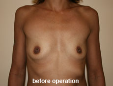 plastic-surgery-breast-augmentation