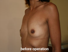 plastic-surgery-breast-augmentation