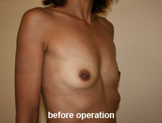 plastic-surgery-breast-augmentation