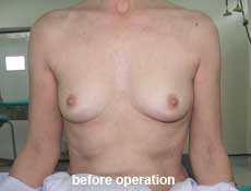 plastic-surgery-breast-augmentation 