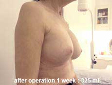 plastic-surgery-breast-augmentation 