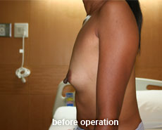 plastic-surgery-breast-augmentation