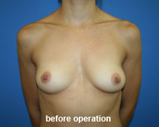 plastic-surgery-breast-augmentation
