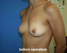 plastic-surgery-breast-augmentation