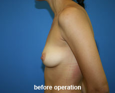 plastic-surgery-breast-augmentation