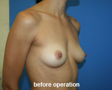 plastic-surgery-breast-augmentation