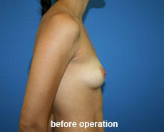 plastic-surgery-breast-augmentation