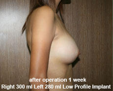 plastic-surgery-breast-augmentation