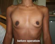 plastic-surgery-breast-augmentation