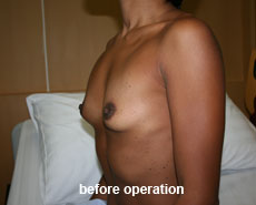 plastic-surgery-breast-augmentation