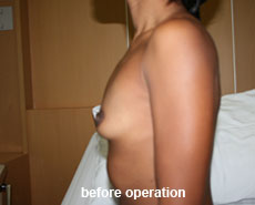 plastic-surgery-breast-augmentation