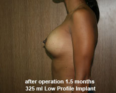 plastic-surgery-breast-augmentation