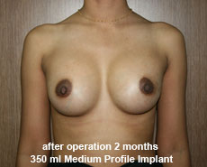 plastic-surgery-breast-augmentation