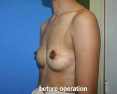 plastic-surgery-breast-augmentation