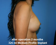 plastic-surgery-breast-augmentation