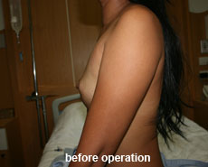 plastic-surgery-breast-augmentation