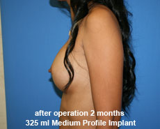 plastic-surgery-breast-augmentation