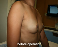 plastic-surgery-breast-augmentation
