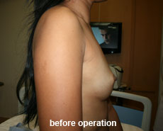 plastic-surgery-breast-augmentation